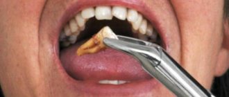 If the tooth falls out easily and painlessly,